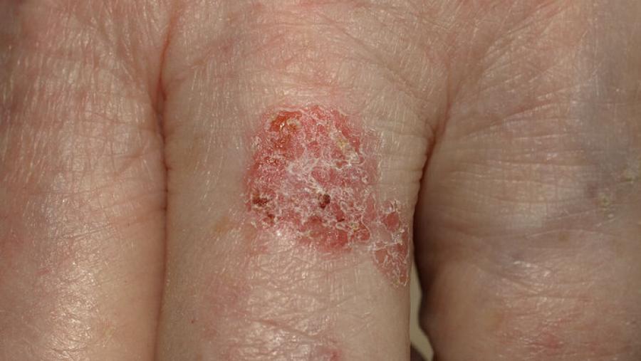 bowen-krankheit und bowen-karzinom – diagnose und therapie
