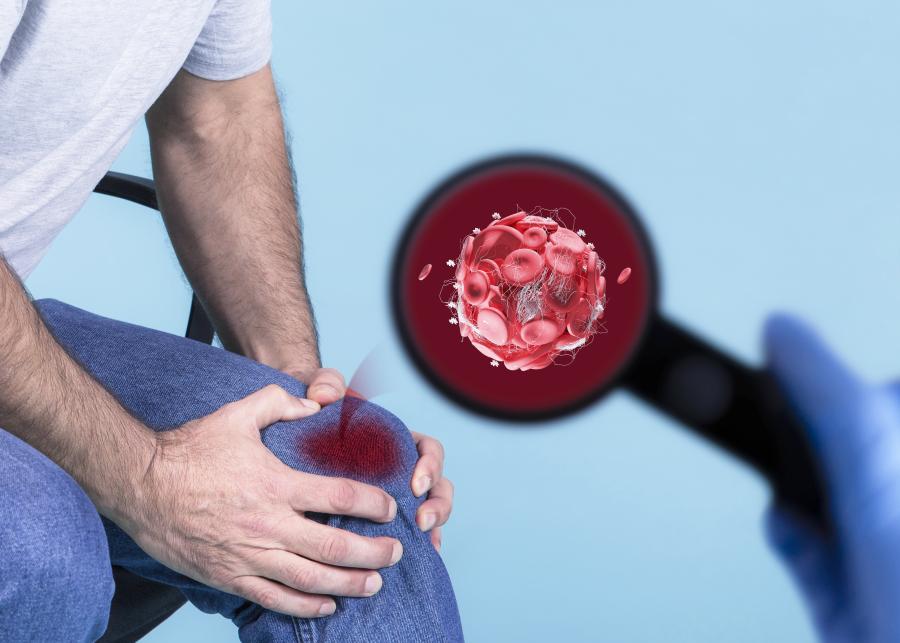 thrombose, blutgerinnsel: symptome