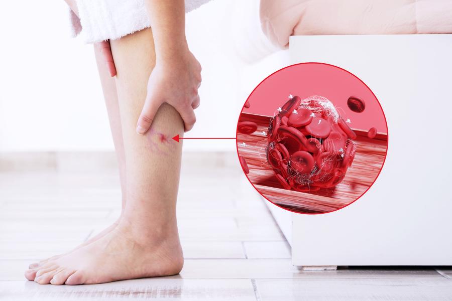 thrombose, blutgerinnsel: diagnose