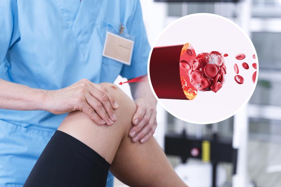 thrombose, blutgerinnsel: komplikationen
