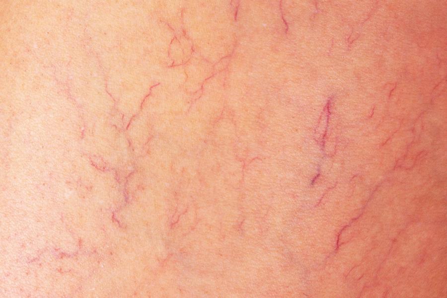 gesunde beine ohne krampfadern und besenreiser