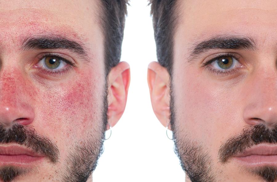 nd:yag-laser – gefäss- & hautbehandlung mit präzision