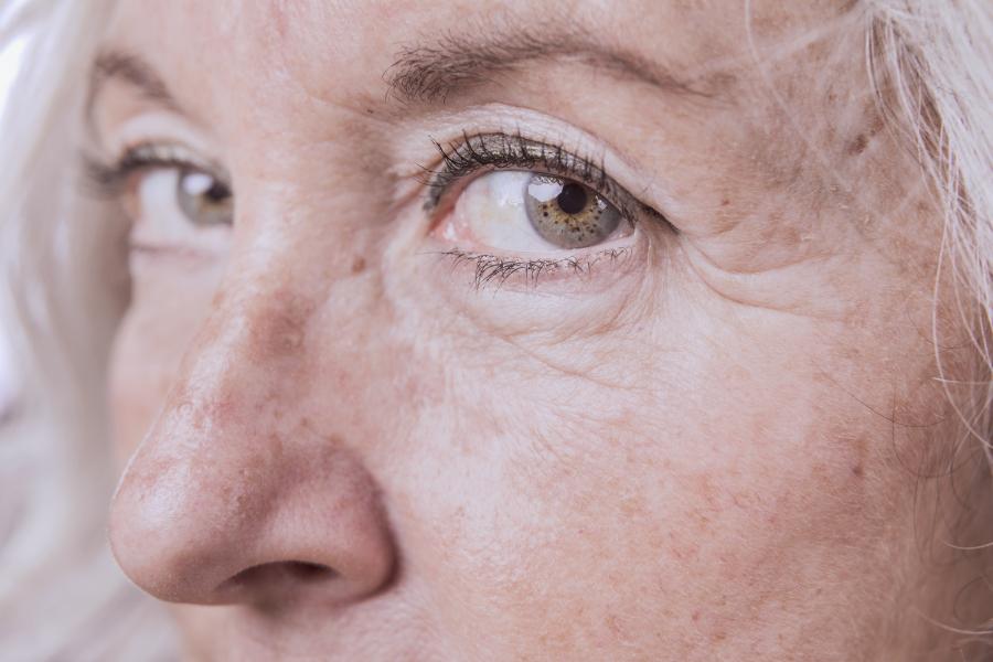 altersflecken, muttermale & leberflecken – behandlung