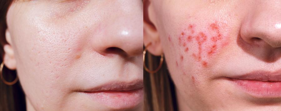 erbium:yag-laser – hautverjüngung mit schneller erholung