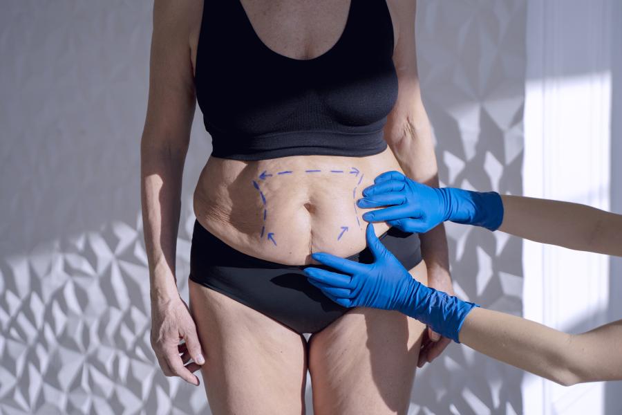 hautstraffung mit bodytite – fettabbau und straffung