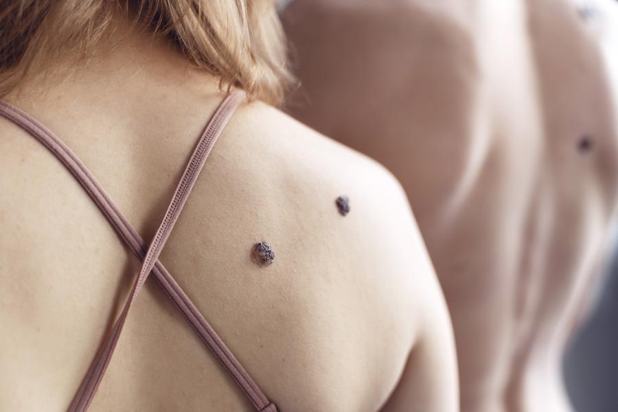 effektive warzenbehandlung – methoden und tipps