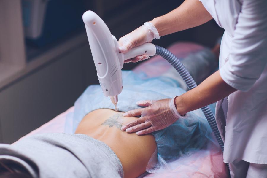 tattooentfernung – sanfte und effektive laserbehandlung