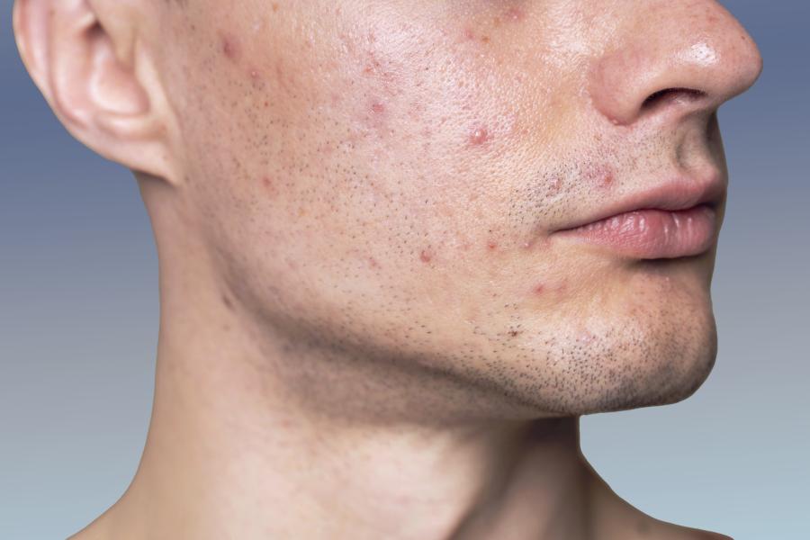 akne-behandlung – effektive therapie gegen pickel & flecken