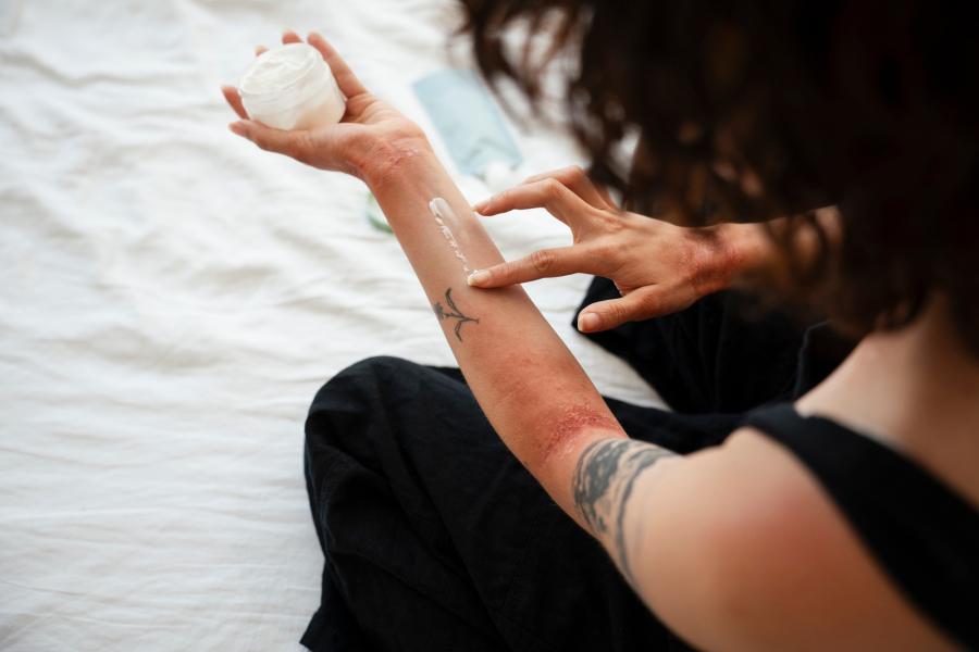 neurodermitis – ursachen, symptome und behandlung