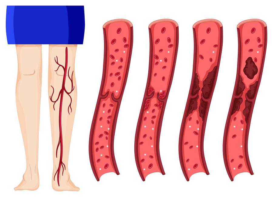 thrombose – ursachen, symptome und behandlung
